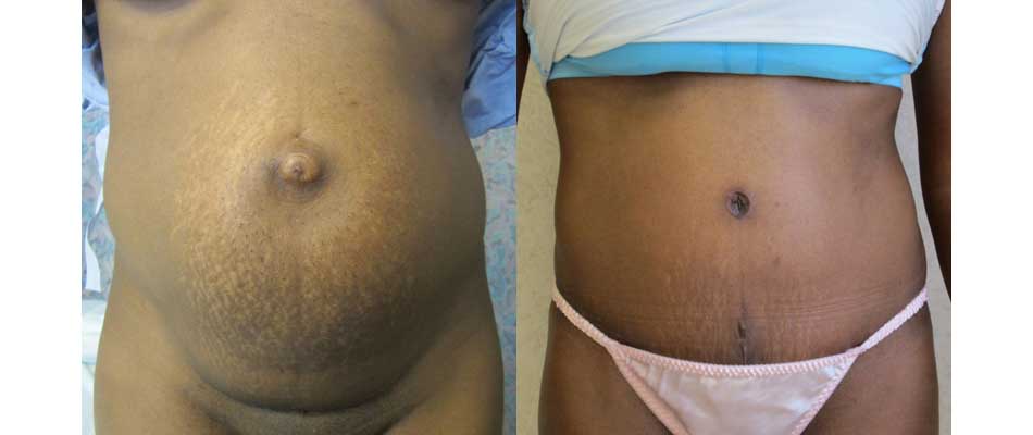 Mini Tummy Tuck After C Section