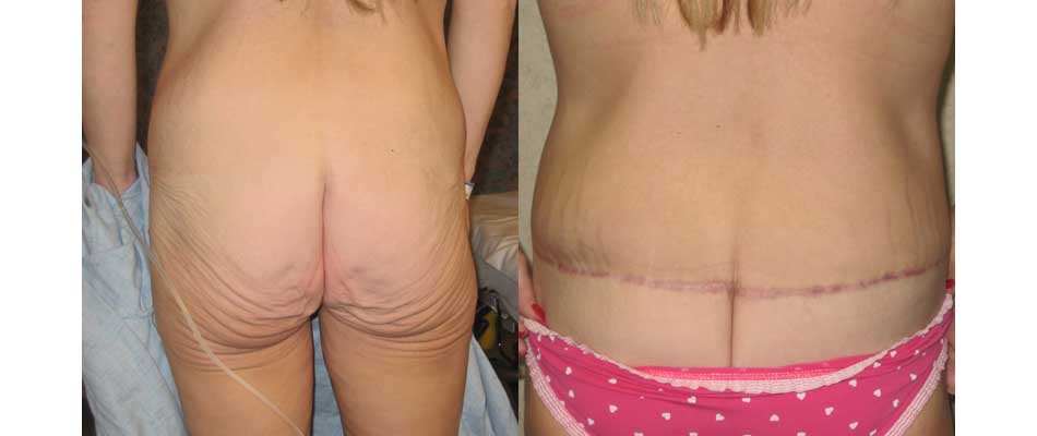 Belt Lipectomy Before and After 03