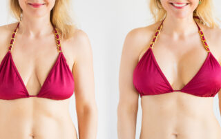 Replacing Breast Implants