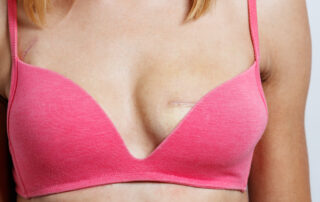 mastectomy reconstruction