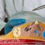 Breast Implant Replacement