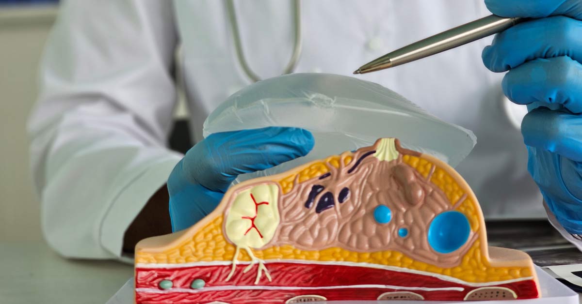 Breast Implant Replacement