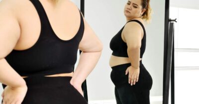 Panniculectomy